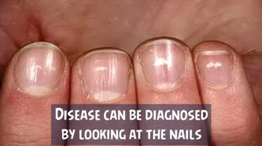 Diseases can be diagnosed by looking at the nails