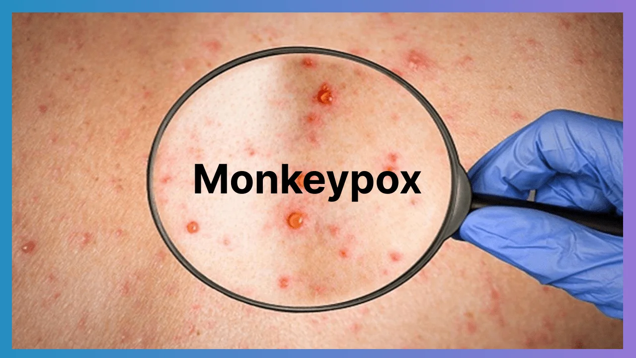 Monkeypox