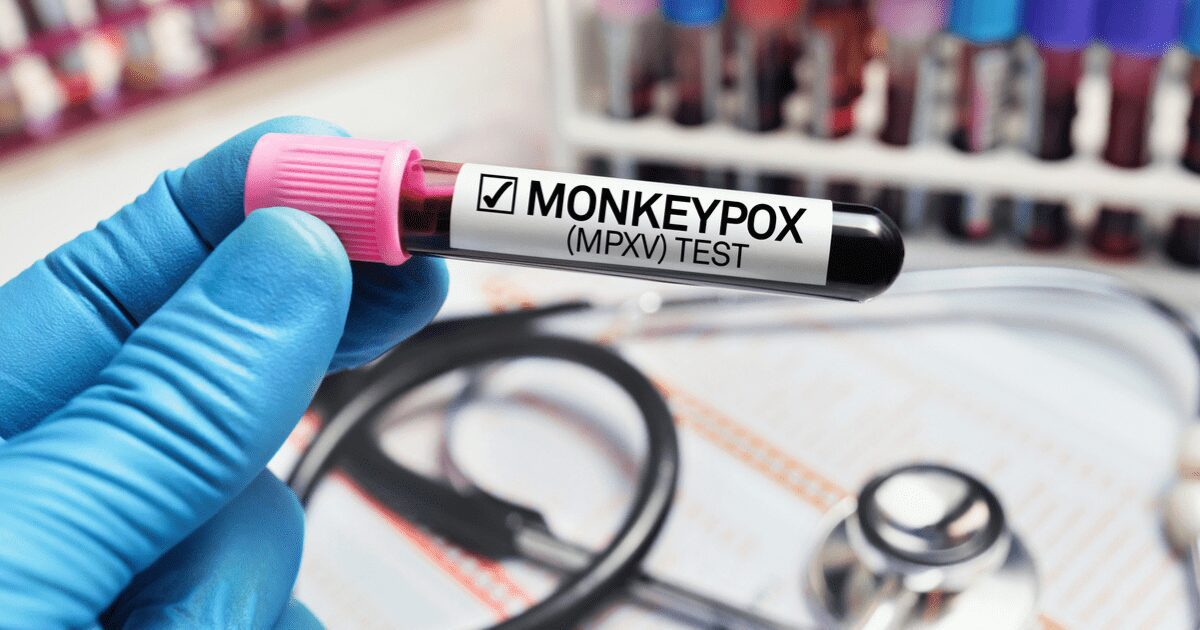 Can you be asymptomatic with monkeypox? Experts answer  | the times of india